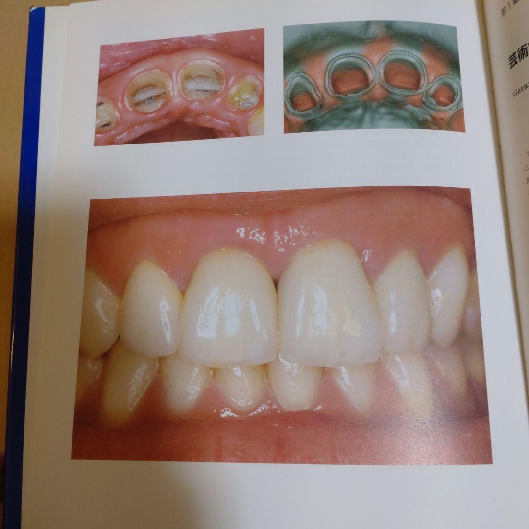 シーシェの審美補綴