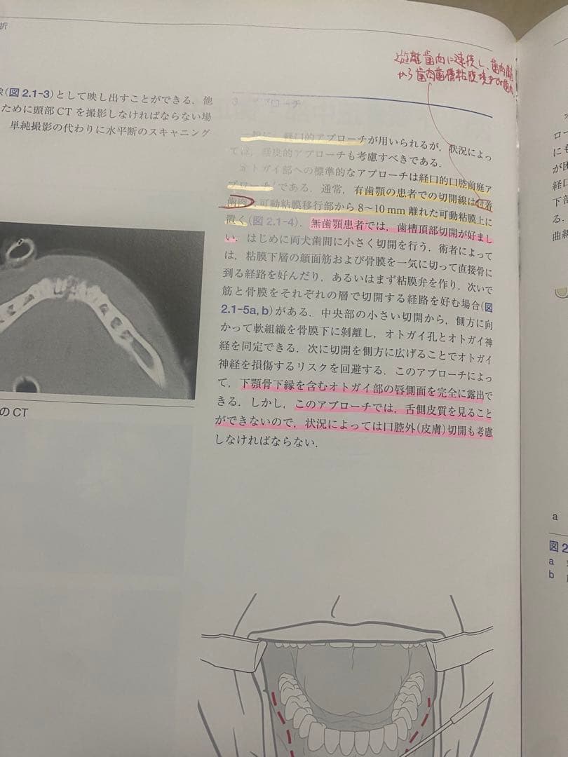 AO法 骨折治療 頭蓋顎顔面骨の内固定