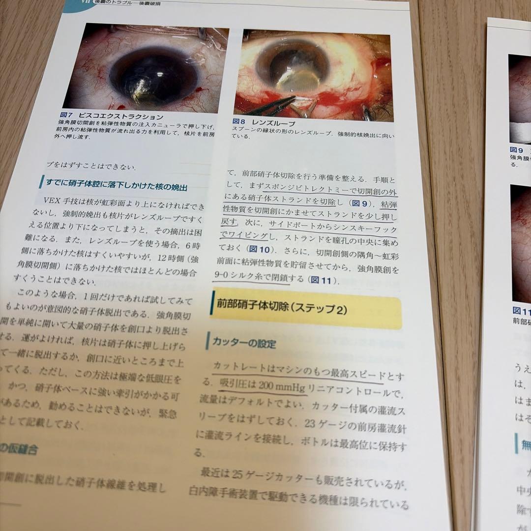 ★裁断済★ 白内障術中トラブルとリカバリーの基本