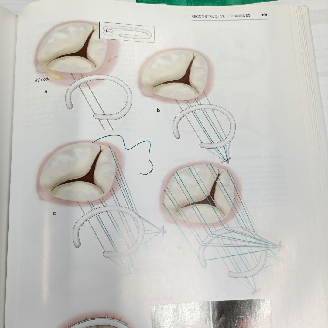 カーペンティアReconstructive valve surgery