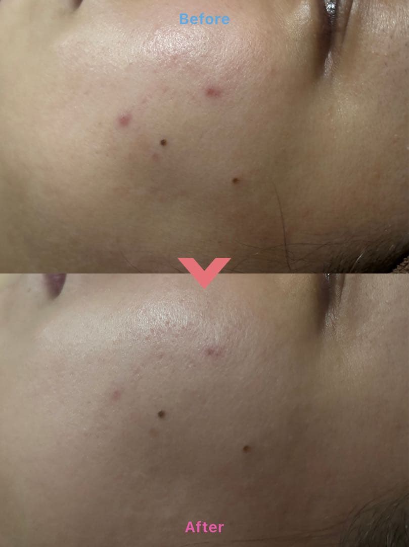 【正規品】プラズマニードルカリファE X美容機器／サロンケア/サロンケア