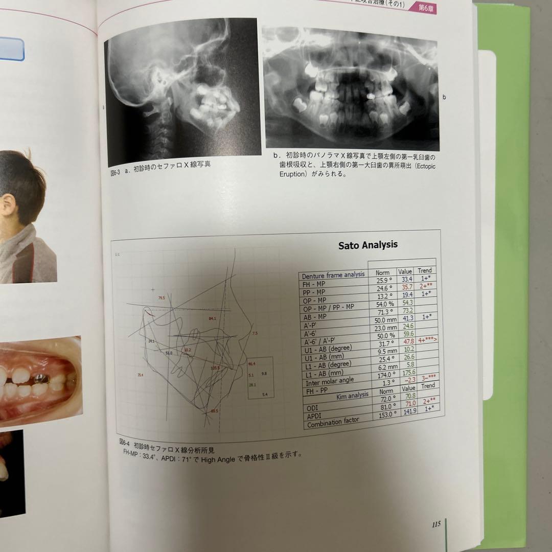 成長・発達期における不正咬合の早期治療